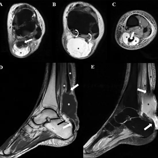 MRI Left Ankle With Cartigram